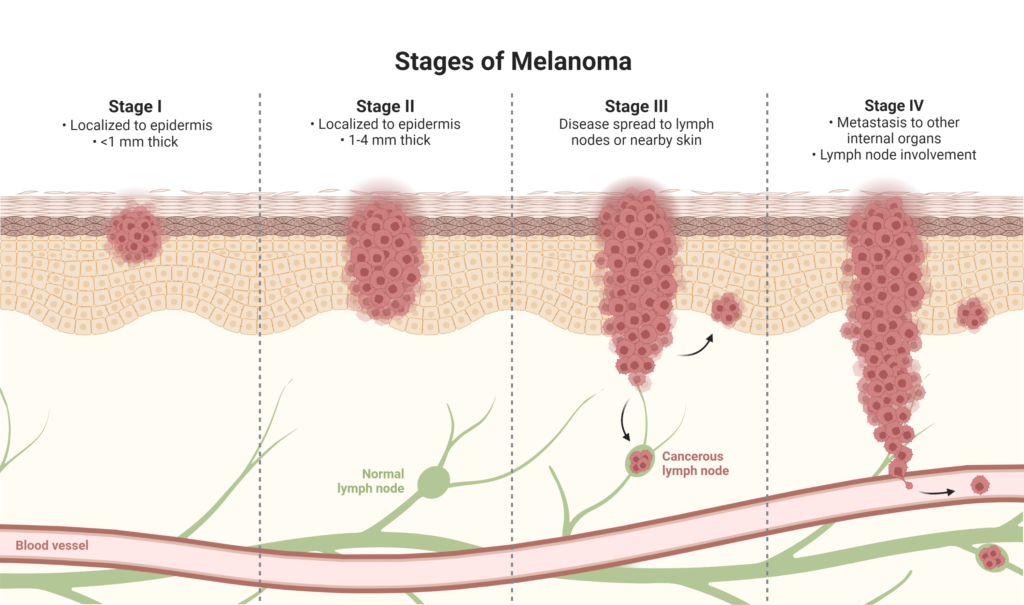 Metastatic melanoma in various stages.